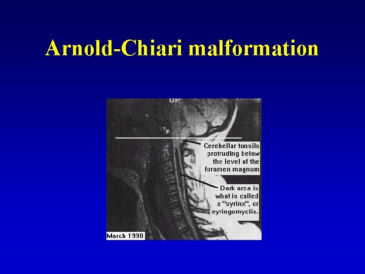 Arnold-Chiari malformation 