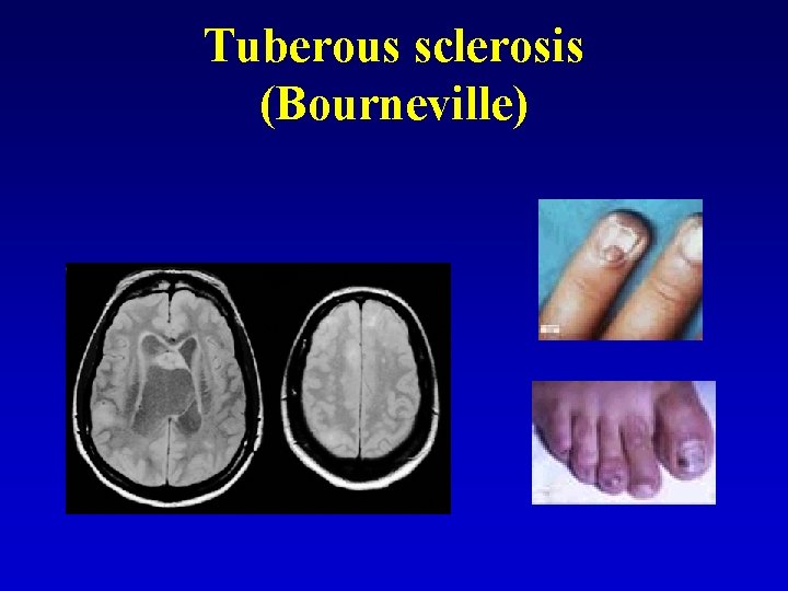 Tuberous sclerosis (Bourneville) 