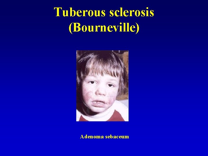 Tuberous sclerosis (Bourneville) Adenoma sebaceum 