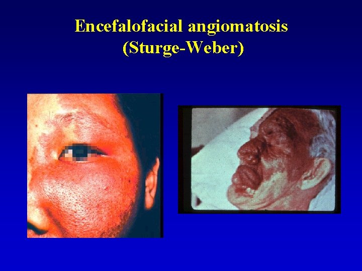 Encefalofacial angiomatosis (Sturge-Weber) 