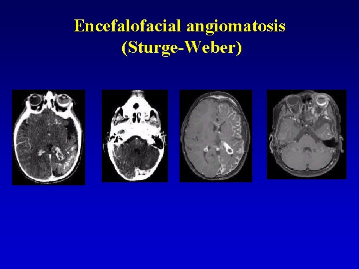 Encefalofacial angiomatosis (Sturge-Weber) 