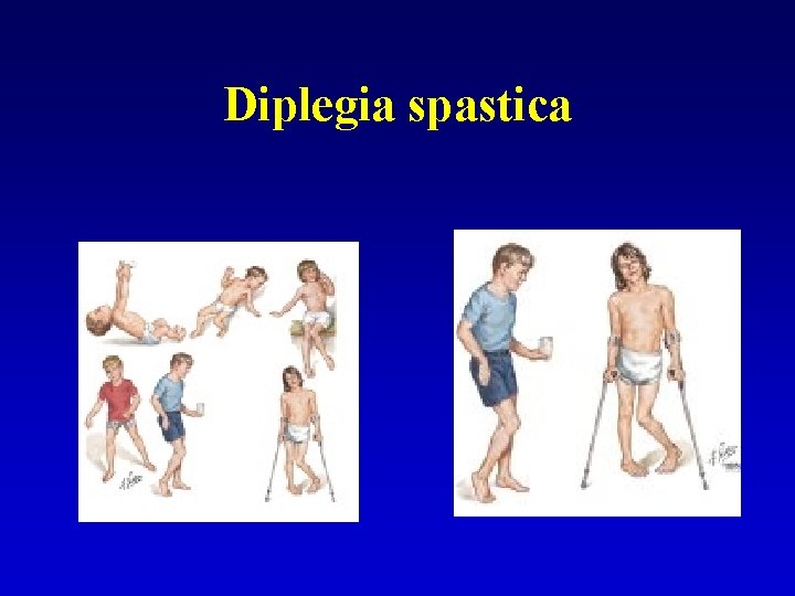 Diplegia spastica 