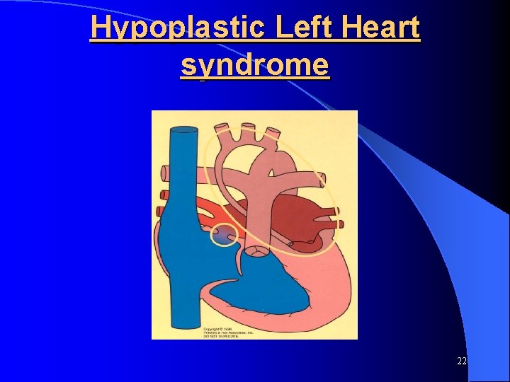 Hypoplastic Left Heart syndrome 22 