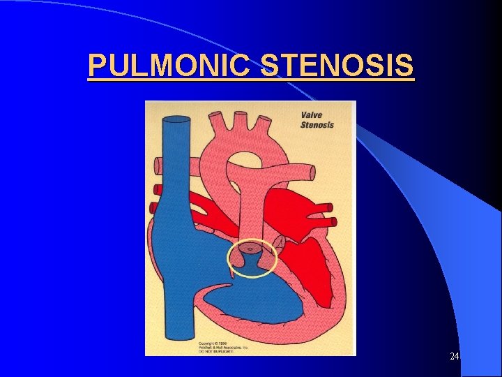 PULMONIC STENOSIS 24 