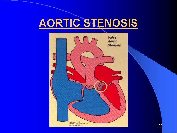 AORTIC STENOSIS 26 