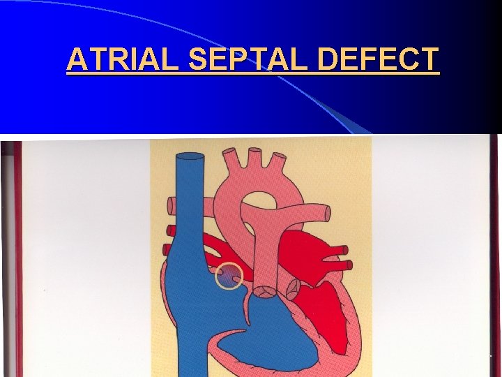 ATRIAL SEPTAL DEFECT 9 