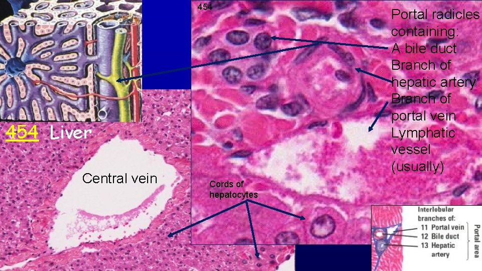 454 Liver Central vein Cords of hepatocytes Portal radicles containing: A bile duct Branch