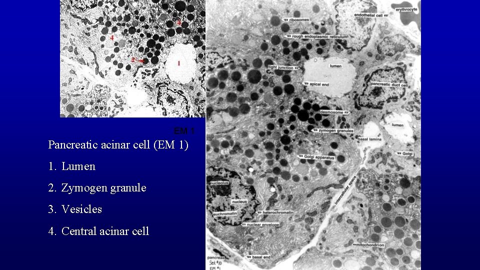 EM 1 Pancreatic acinar cell (EM 1) 1. Lumen 2. Zymogen granule 3. Vesicles