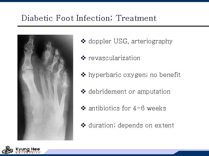 Diabetic Foot Infection; Treatment v doppler USG, arteriography v revascularization v hyperbaric oxygen; no