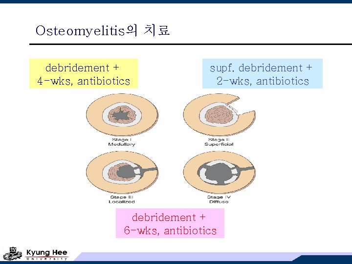 Osteomyelitis의 치료 debridement + 4 -wks, antibiotics supf. debridement + 2 -wks, antibiotics debridement