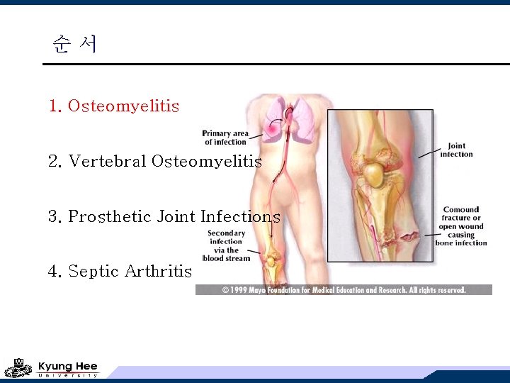 순서 1. Osteomyelitis 2. Vertebral Osteomyelitis 3. Prosthetic Joint Infections 4. Septic Arthritis 