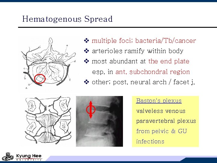 Hematogenous Spread v multiple foci; bacteria/Tb/cancer v arterioles ramify within body v most abundant