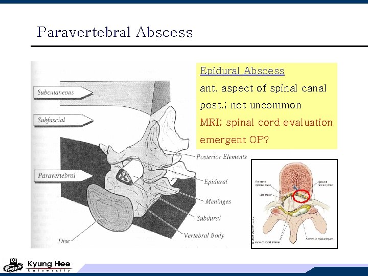 Paravertebral Abscess Epidural Abscess ant. aspect of spinal canal post. ; not uncommon MRI;