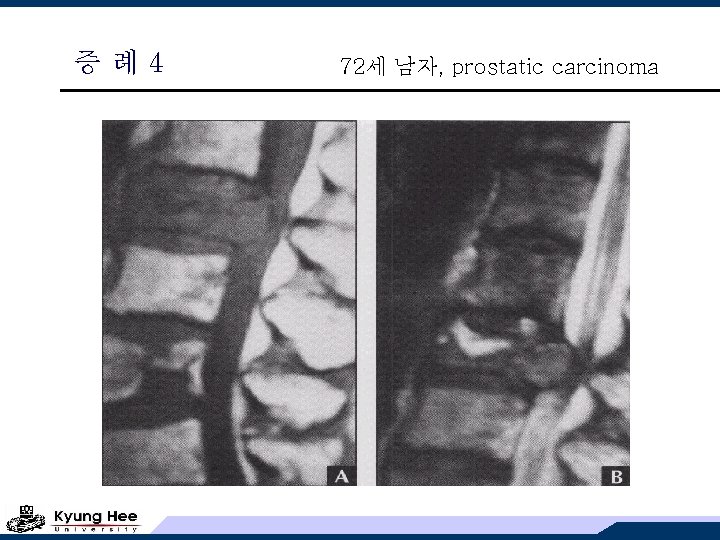 증례4 72세 남자, prostatic carcinoma 