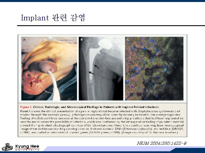 Implant 관련 감염 NEJM 2004; 350: 1422 -9 