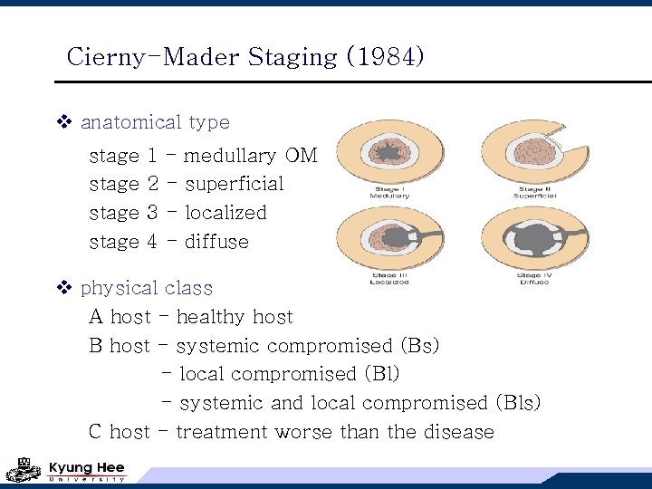 Cierny-Mader Staging (1984) v anatomical type stage 1 2 3 4 - medullary OM