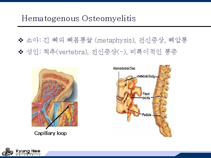 Hematogenous Osteomyelitis v 소아: 긴 뼈의 뼈몸통끝 (metaphysis), 전신증상, 뼈압통 v 성인: 척추(vertebra), 전신증상(-),