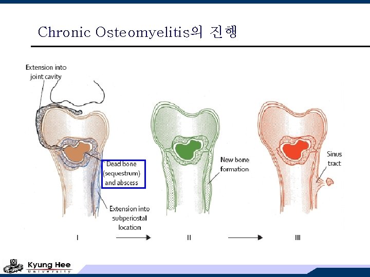 Chronic Osteomyelitis의 진행 