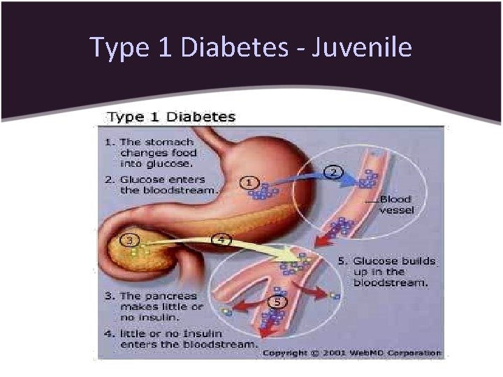 Type 1 Diabetes - Juvenile 
