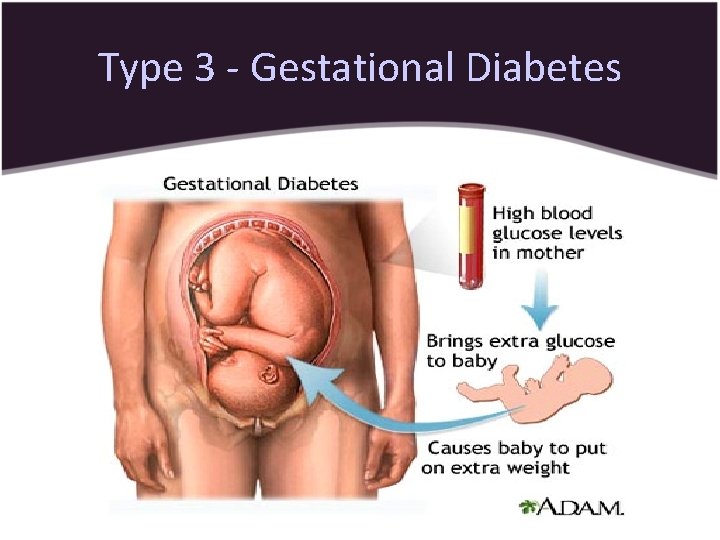 Type 3 - Gestational Diabetes 