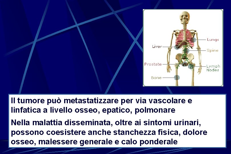 Il tumore può metastatizzare per via vascolare e linfatica a livello osseo, epatico, polmonare