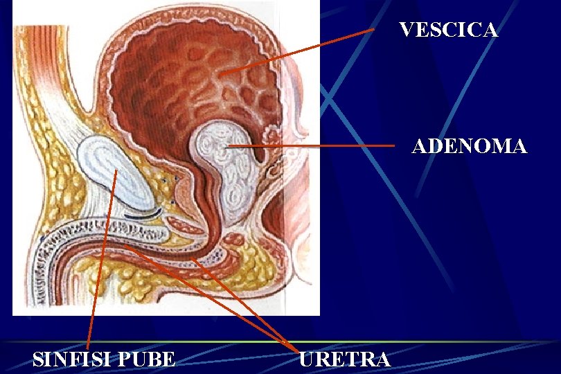 VESCICA ADENOMA SINFISI PUBE URETRA 