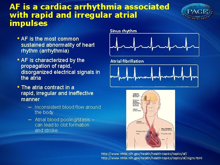 AF is a cardiac arrhythmia associated with rapid and irregular atrial impulses Sinus rhythm