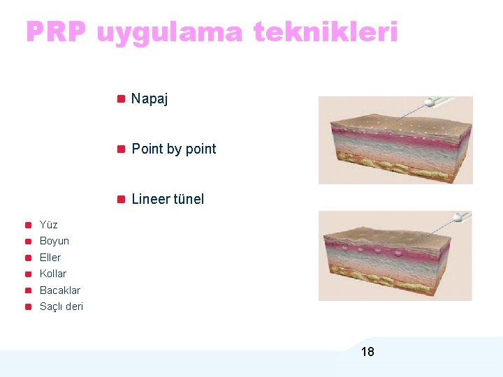 PRP uygulama teknikleri Napaj Point by point Lineer tünel Yüz Boyun Eller Kollar Bacaklar