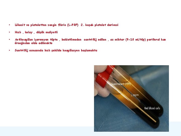  • Lökosit ve plateletten zengin fibrin (L-PRF) 2. kuşak platelet derivesi • Hızlı