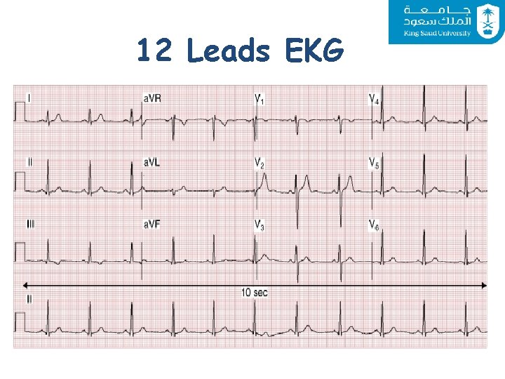 12 Leads EKG 