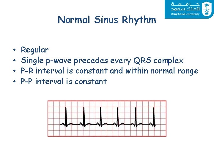 Normal Sinus Rhythm • • Regular Single p-wave precedes every QRS complex P-R interval