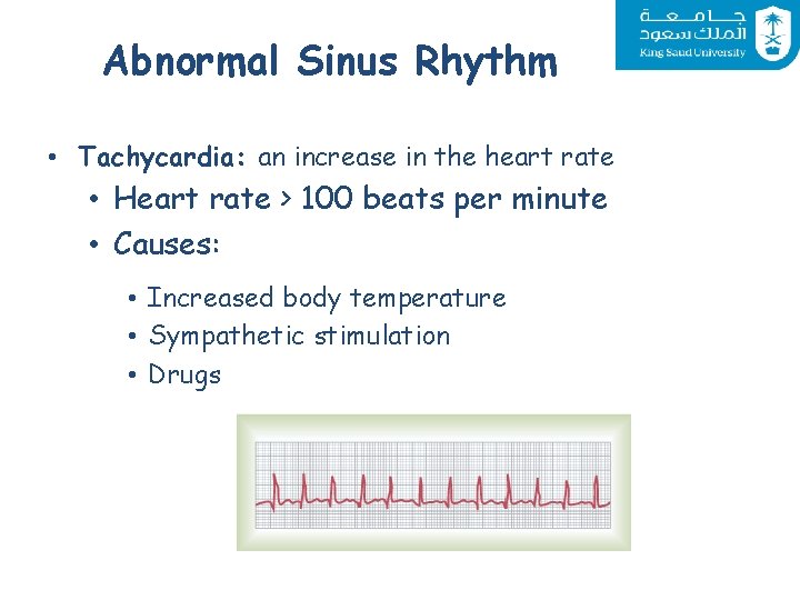 Abnormal Sinus Rhythm • Tachycardia: an increase in the heart rate • Heart rate