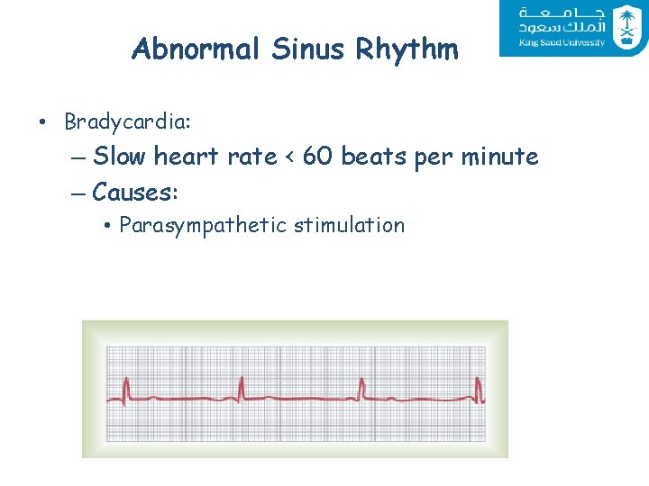Abnormal Sinus Rhythm • Bradycardia: – Slow heart rate < 60 beats per minute
