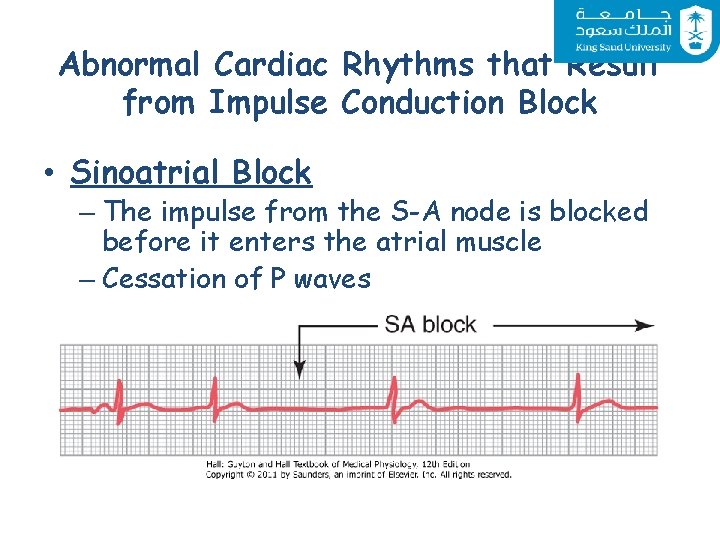 Abnormal Cardiac Rhythms that Result from Impulse Conduction Block • Sinoatrial Block – The