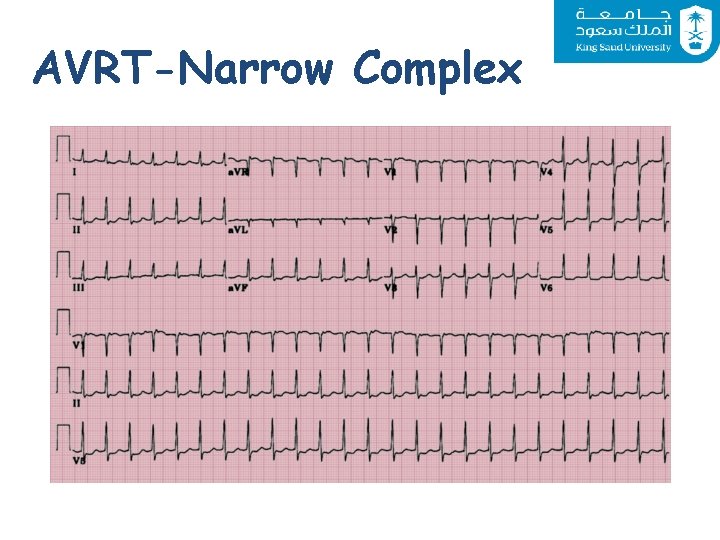 AVRT-Narrow Complex 
