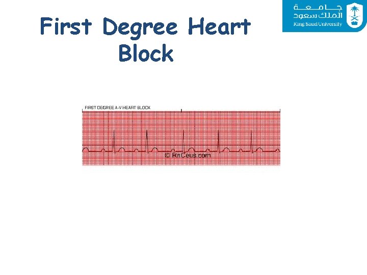 First Degree Heart Block 