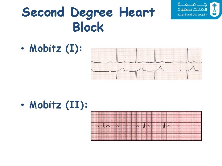 Second Degree Heart Block • Mobitz (I): • Mobitz (II): 