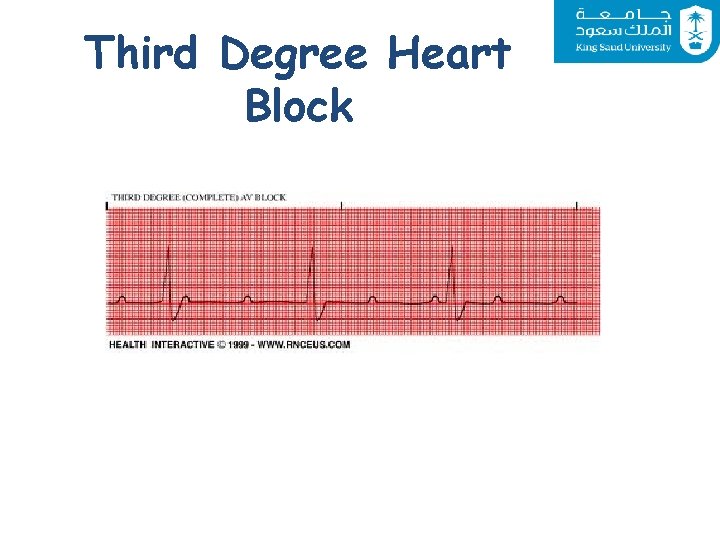 Third Degree Heart Block 