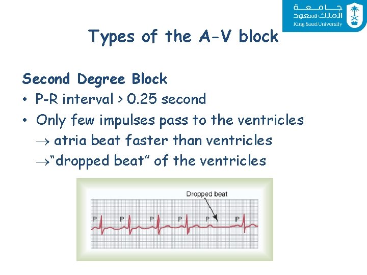 Types of the A-V block Second Degree Block • P-R interval > 0. 25