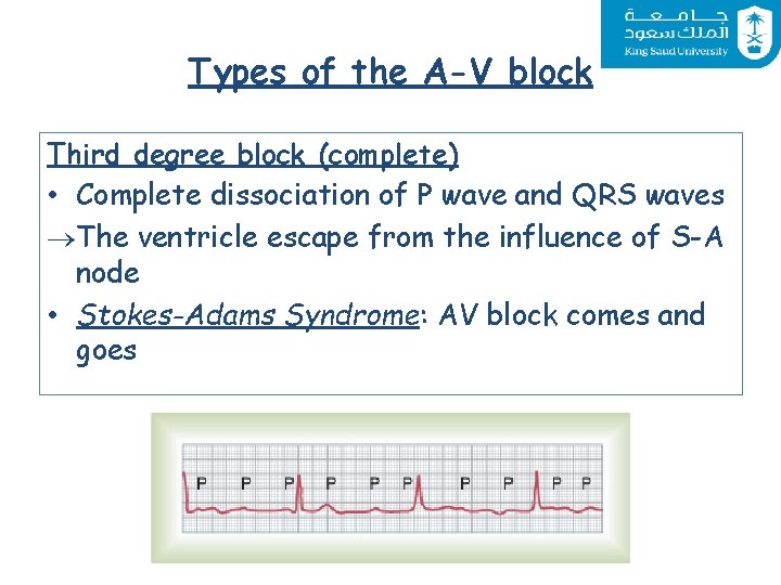 Types of the A-V block Third degree block (complete) • Complete dissociation of P