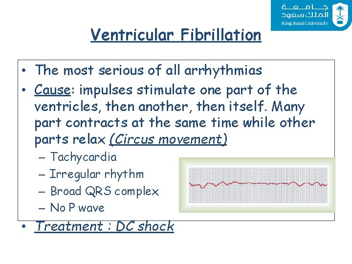 Ventricular Fibrillation • The most serious of all arrhythmias • Cause: impulses stimulate one
