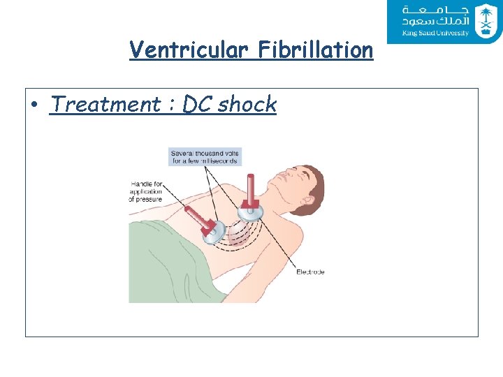 Ventricular Fibrillation • Treatment : DC shock 