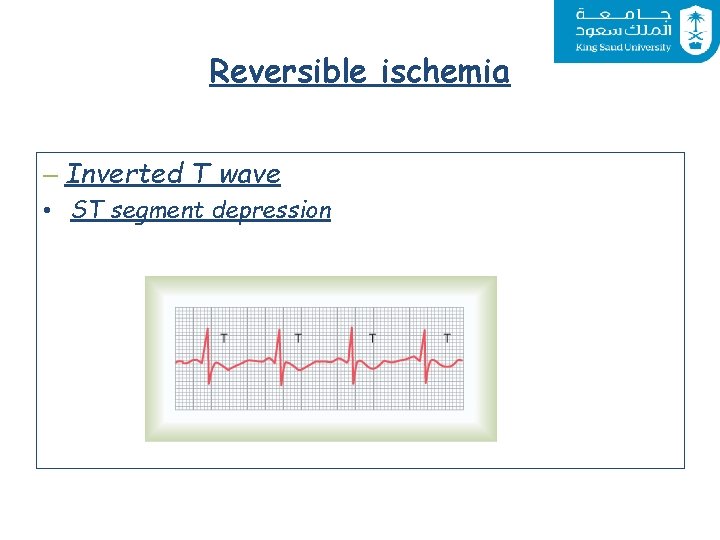 Reversible ischemia – Inverted T wave • ST segment depression 