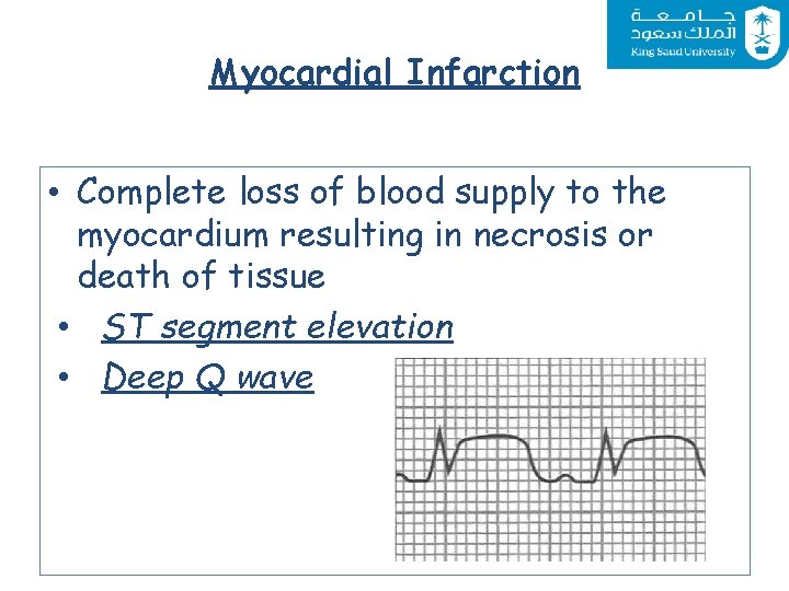Myocardial Infarction • Complete loss of blood supply to the myocardium resulting in necrosis
