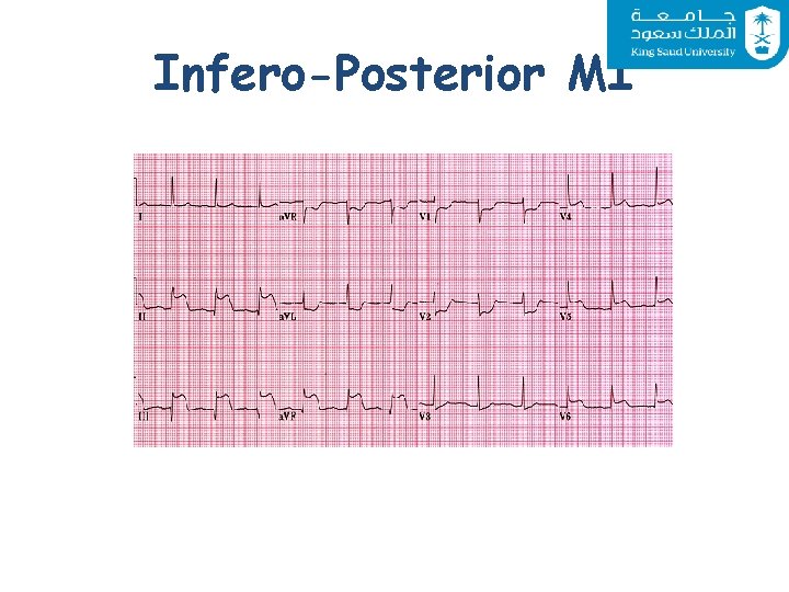 Infero-Posterior MI 