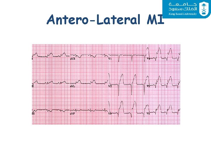 Antero-Lateral MI 