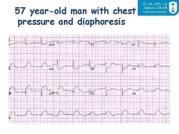 57 year-old man with chest pressure and diaphoresis 