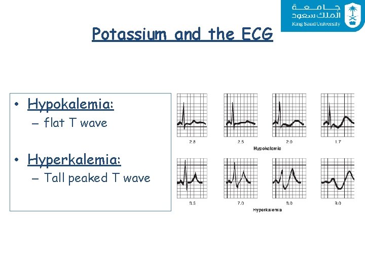 Potassium and the ECG • Hypokalemia: – flat T wave • Hyperkalemia: – Tall