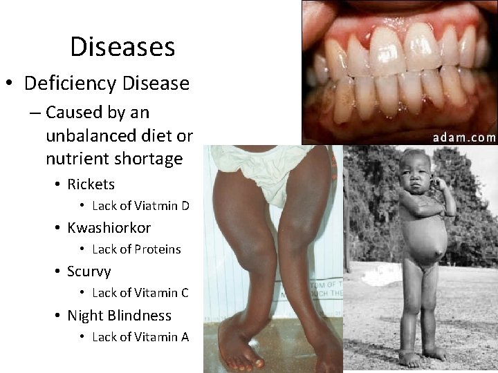 Diseases • Deficiency Disease – Caused by an unbalanced diet or nutrient shortage •