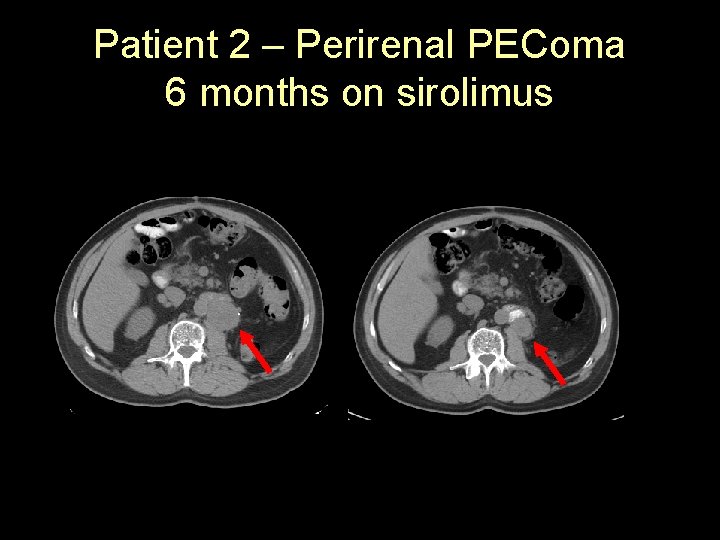 Patient 2 – Perirenal PEComa 6 months on sirolimus 